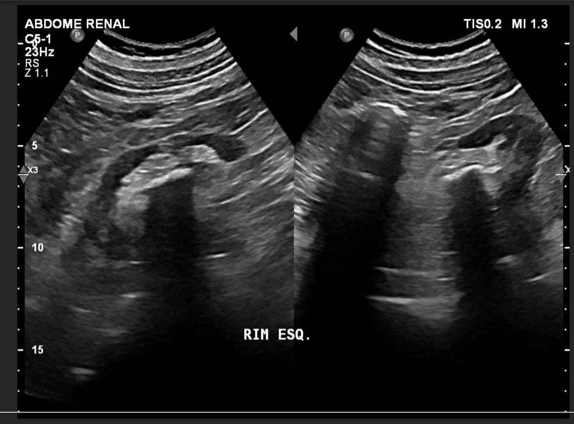 Cálculos renais e vesicais na tetraplegia